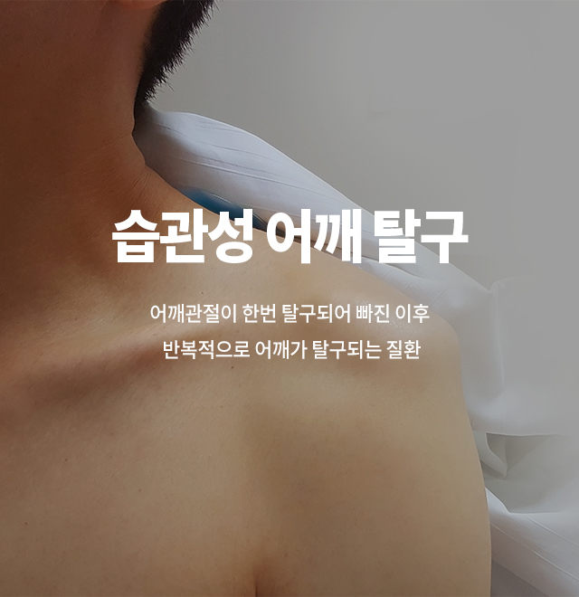 습관성어깨탈구