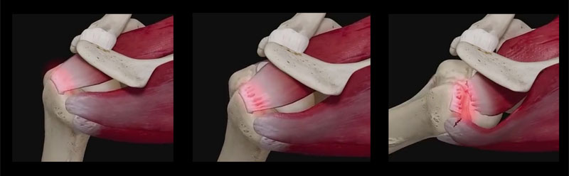 회전근개파열 패치봉합술