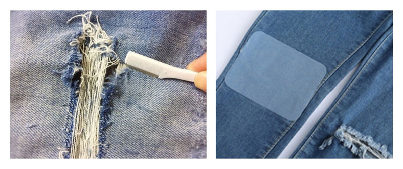 회전근개파열 패치봉합술