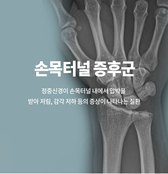 손목터널증후군