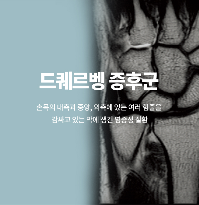 드퀘르벵증후군