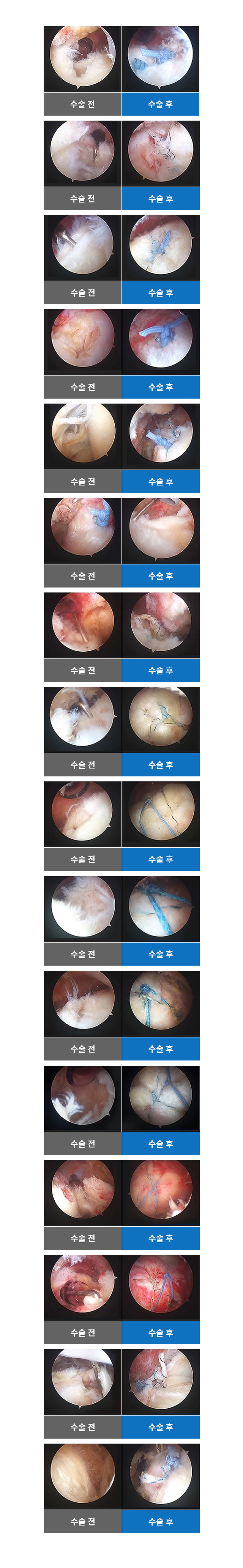 회전근개파열 수술사례