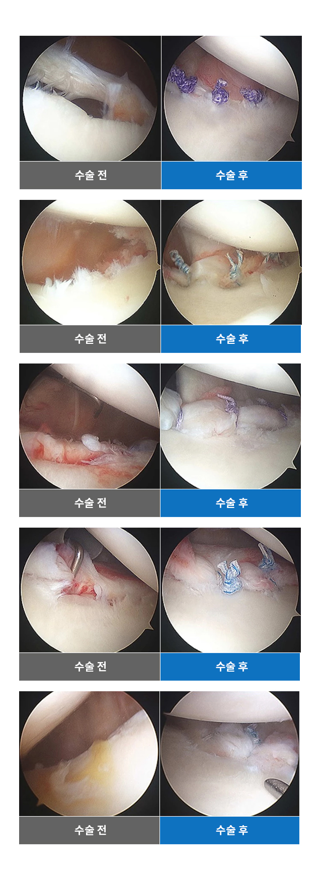 어깨탈골 수술사례