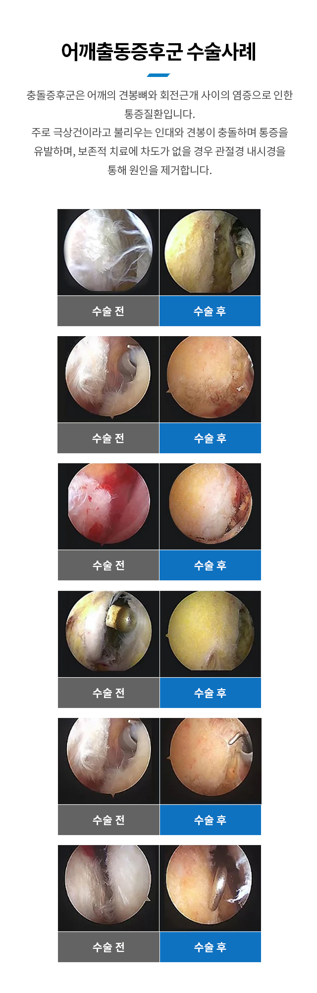 어깨충돌증후군 수술사례