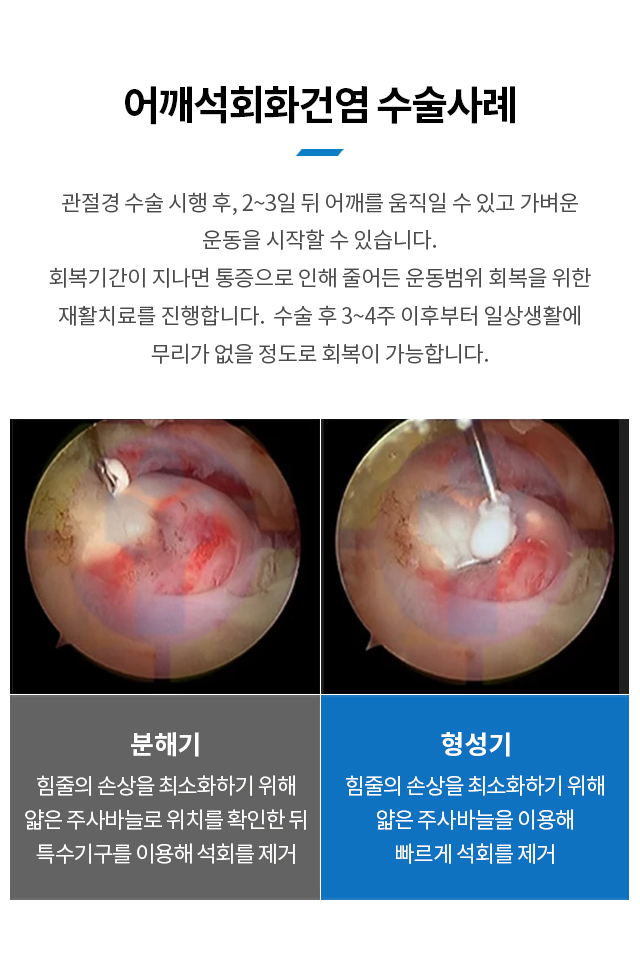 어깨석회화건염 수술사례